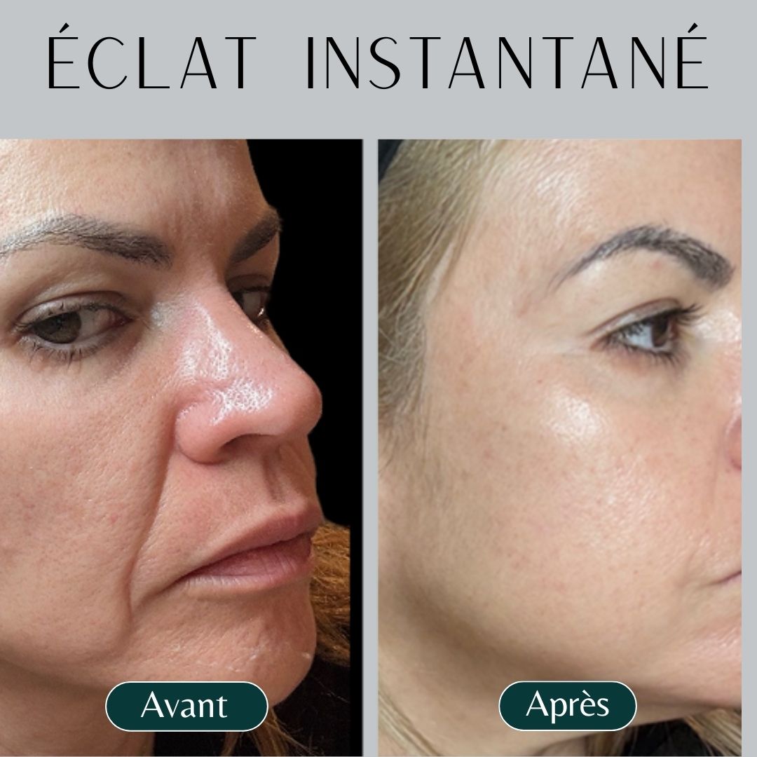 Le système de micro-infusion