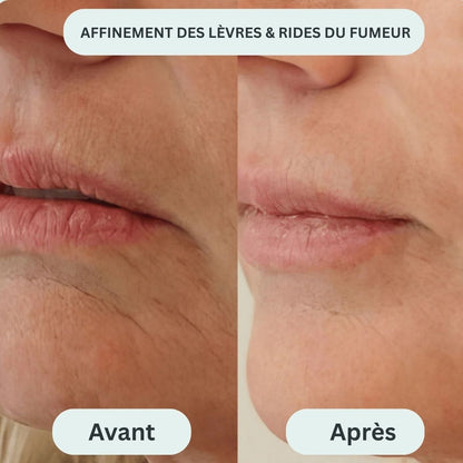 Le système de micro-infusion