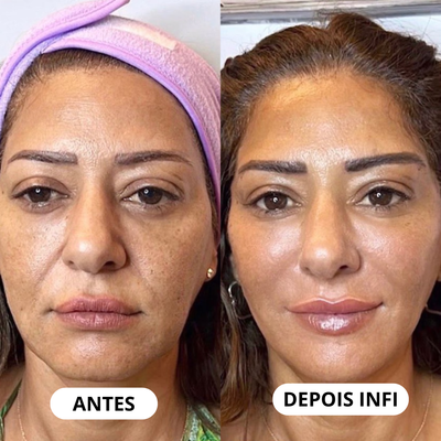 Micro-Infusão Lift Pro