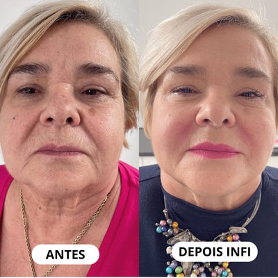 Micro-Infusão Lift Pro