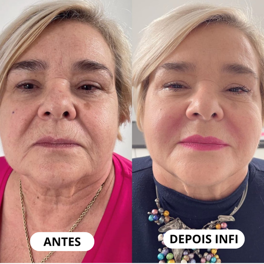 Micro-Infusão Lift Pro