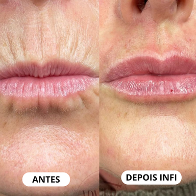 Micro-Infusão Lift Pro