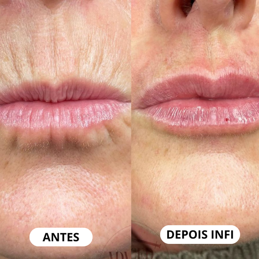 Micro-Infusão Lift Pro