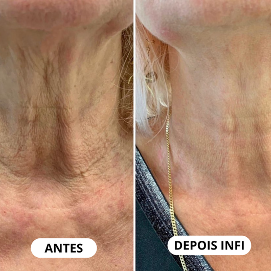 Micro-Infusão Lift Pro