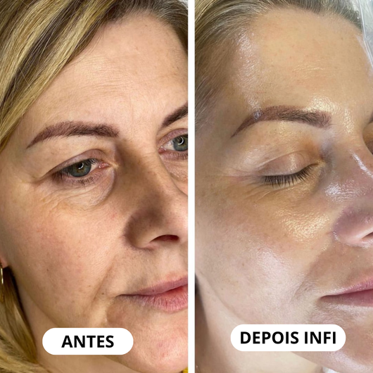 Micro-Infusão Lift Pro