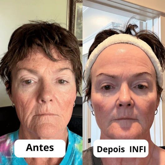 Micro-Infusão Lift Pro