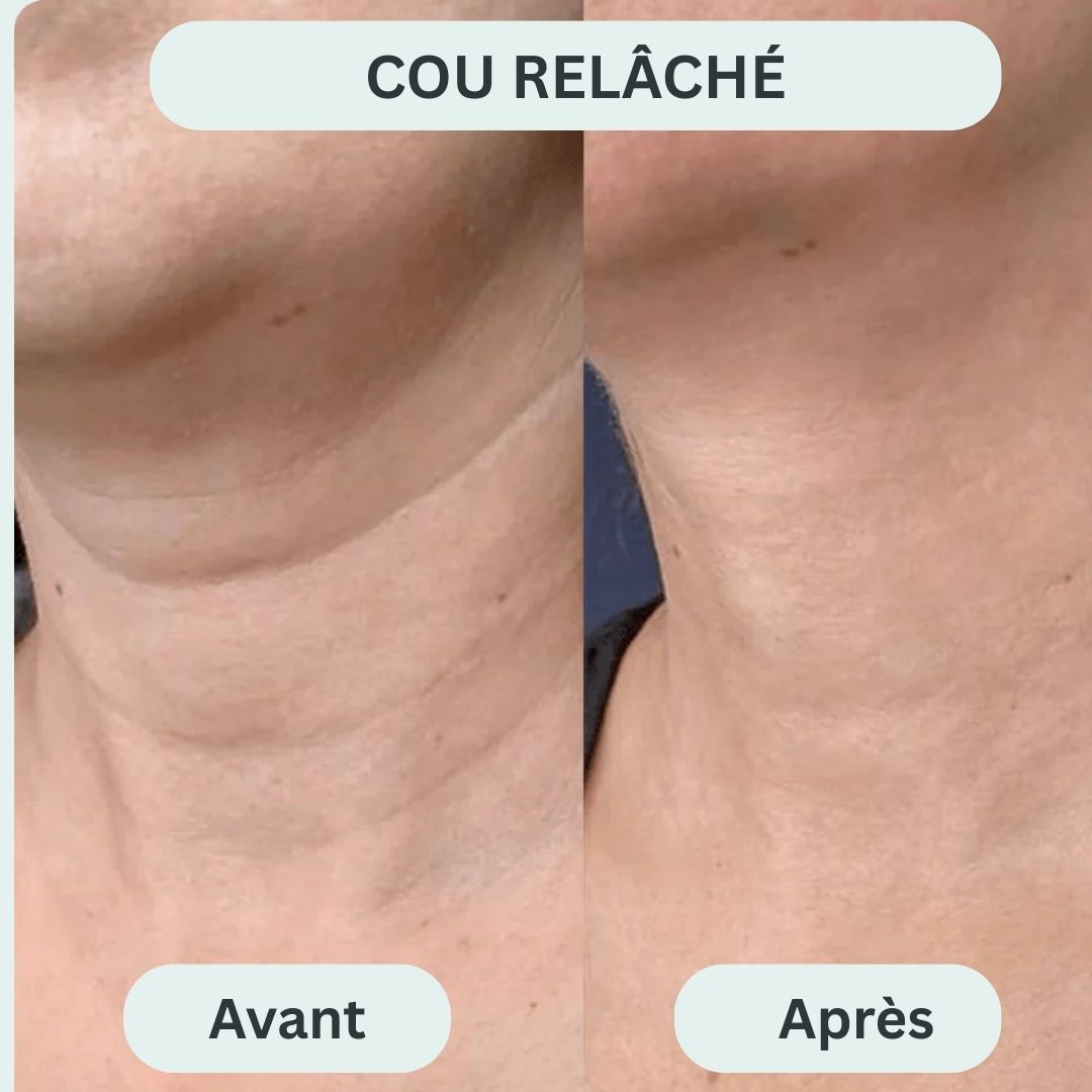 Le système de micro-infusion