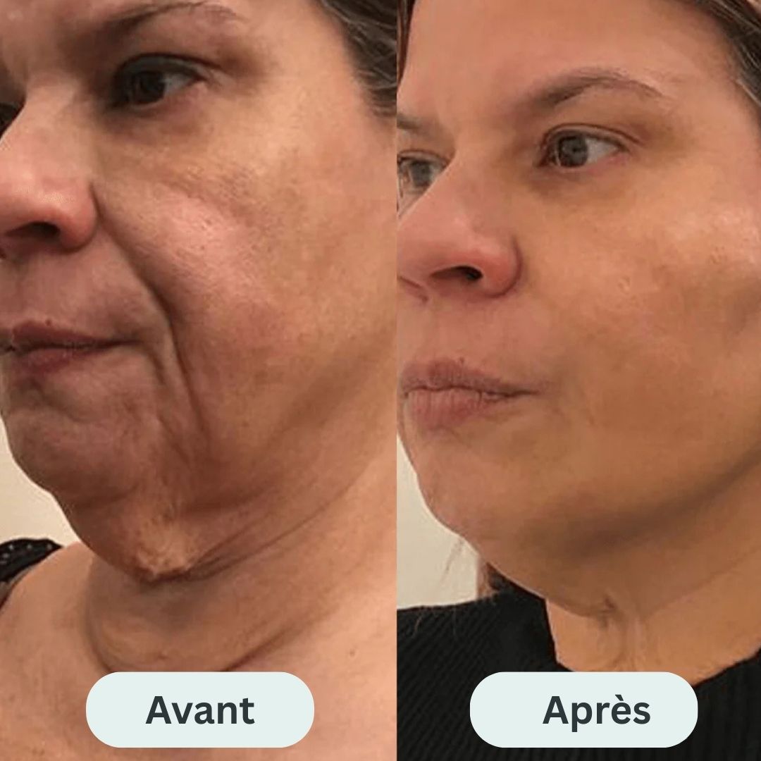 Le système de micro-infusion