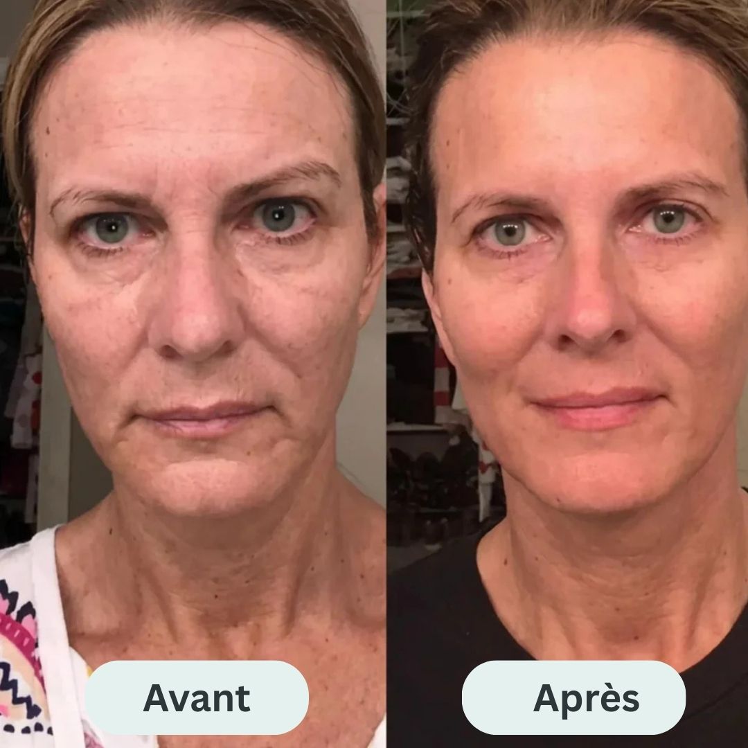 Le système de micro-infusion