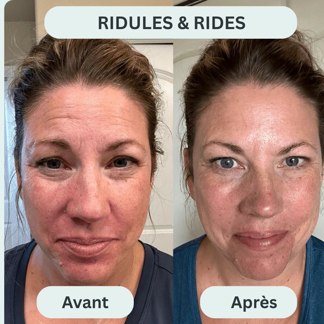 Le système de micro-infusion